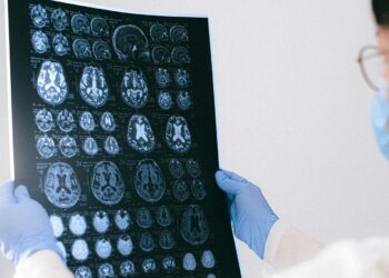 Unlocking the Mind: How Your Diet and Lifestyle Can Combat Age-Related Brain Disorders, Says New Study